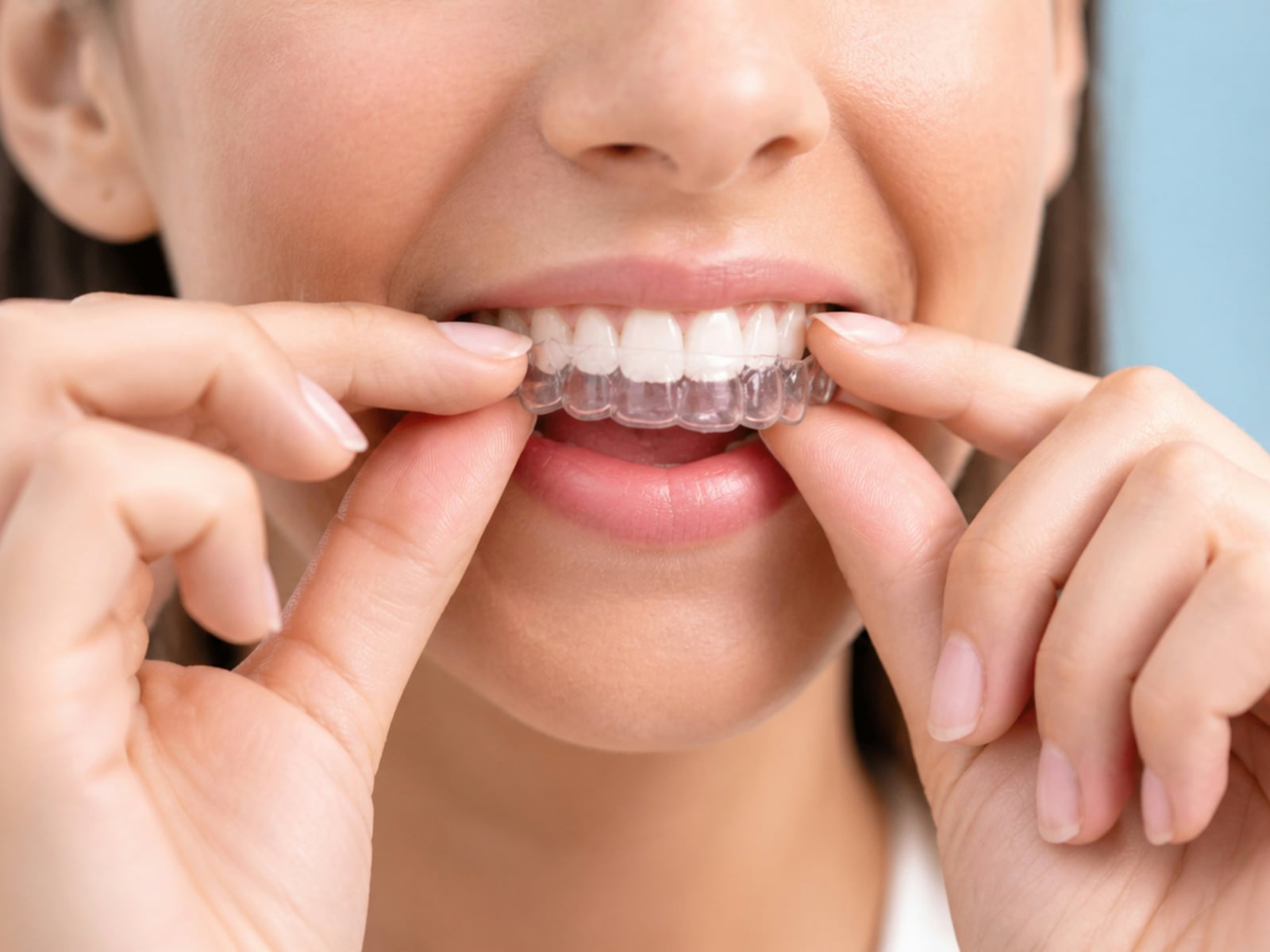 Patient fitting a clear aligner over her top teeth