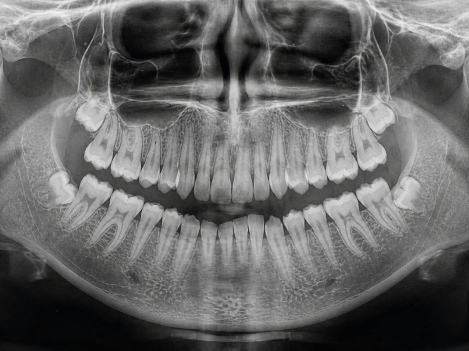 Panoramic X-ray of the upper and lower teeth