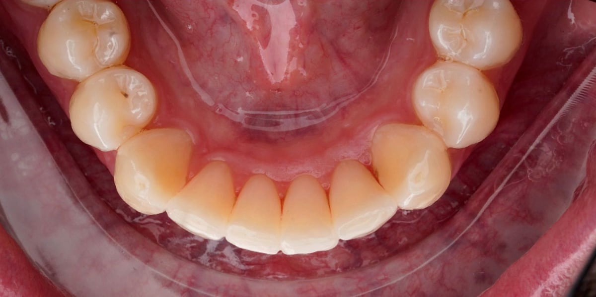 Invisalign case, after