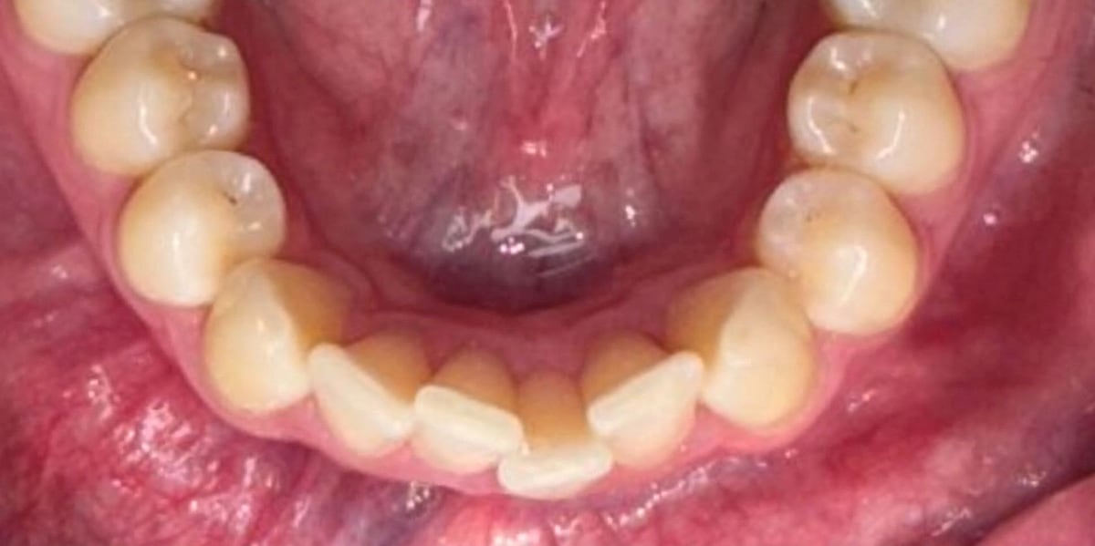 Invisalign case, before
