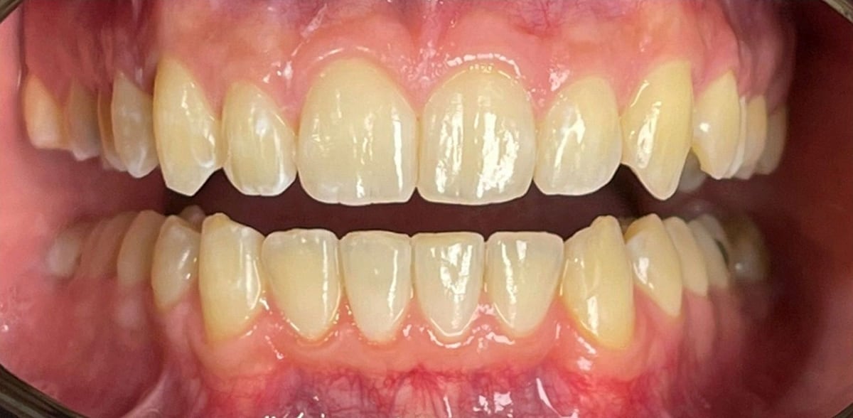 Invisalign case, after