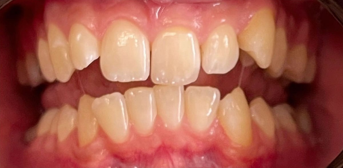 Invisalign case, before