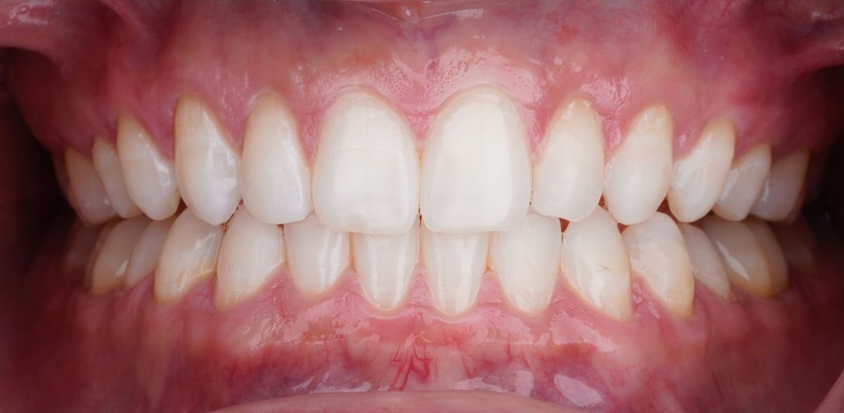 Invisalign case, after