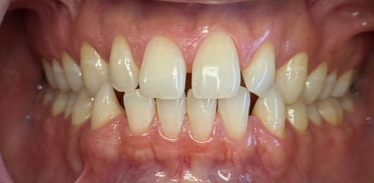 Invisalign case, before