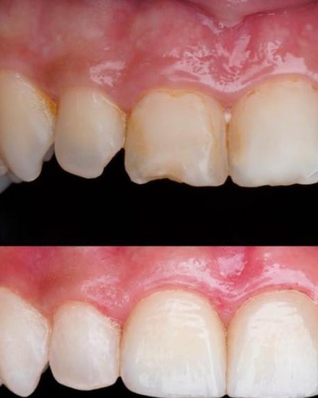 Invisalign, whitening, two porcelain veneers and bonding.
