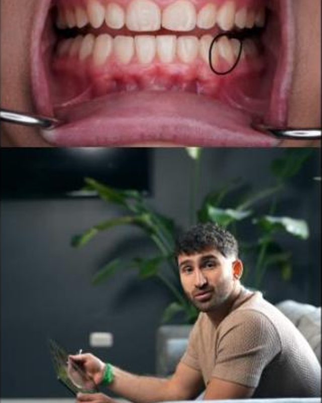 Breakdown of one of my favorite Invisalign cases.