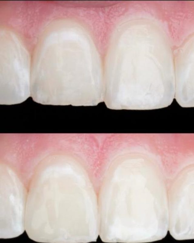 A tiny chip in a front tooth, fixed with bonding.