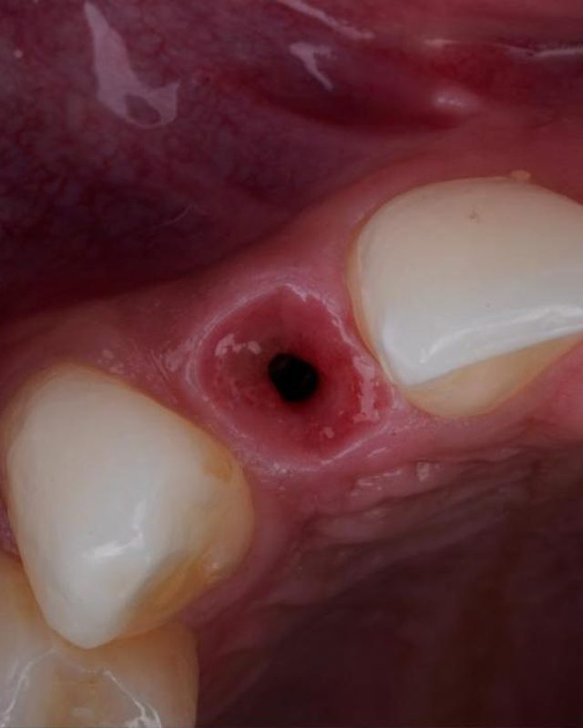 Healed soft tissue around an implant.
