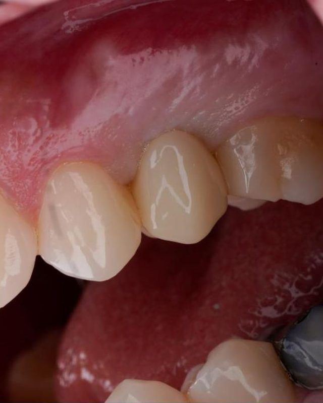 Implant crown on tooth #4, five minutes after seating.