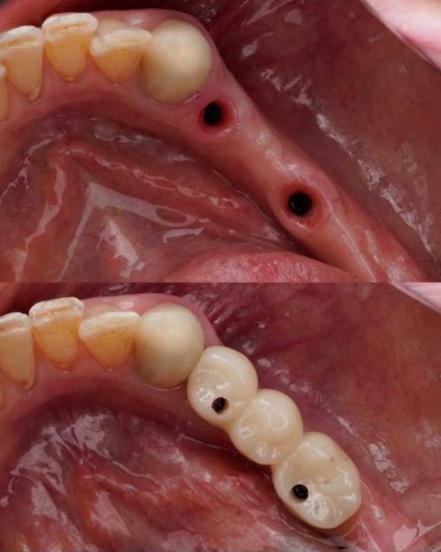 Years without his back teeth. Not anymore.