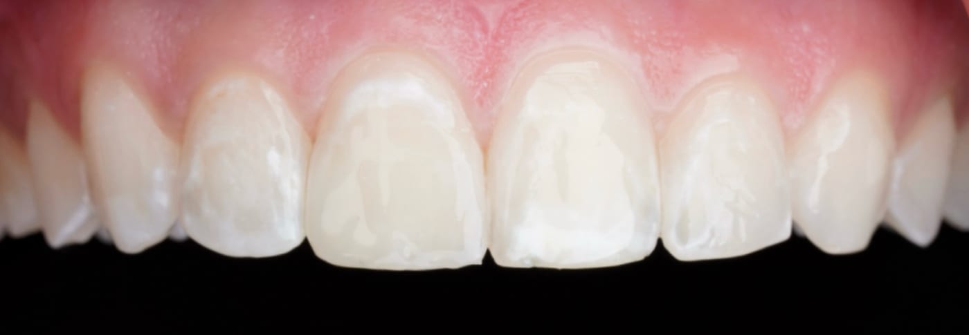 A chipped front tooth, repaired in one visit, after