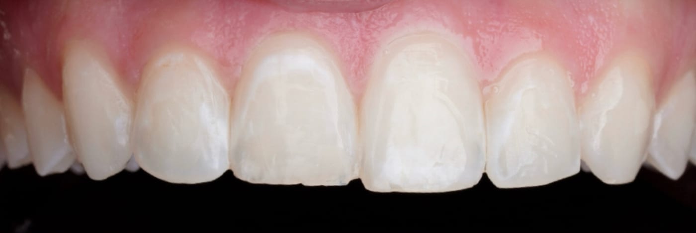 A chipped front tooth, repaired in one visit, before