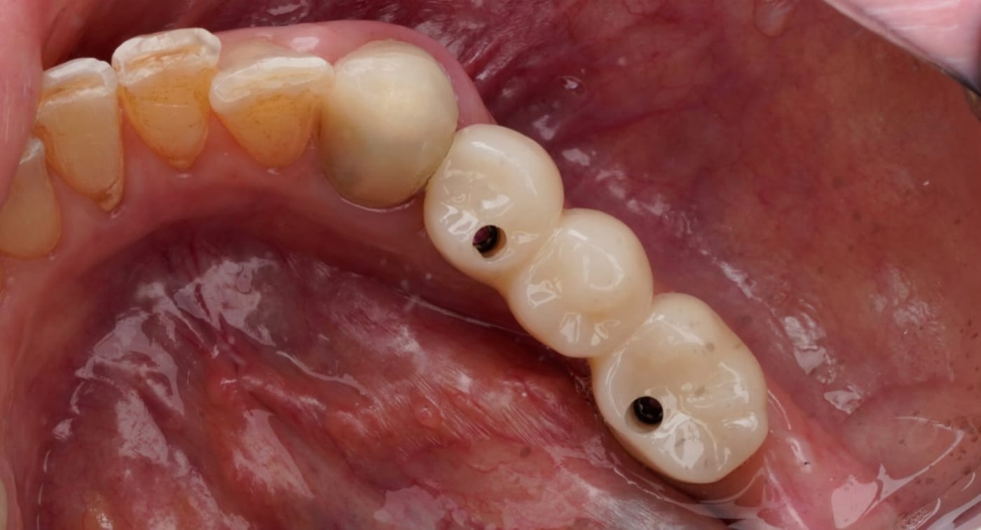Missing back teeth replaced with an implant bridge, after