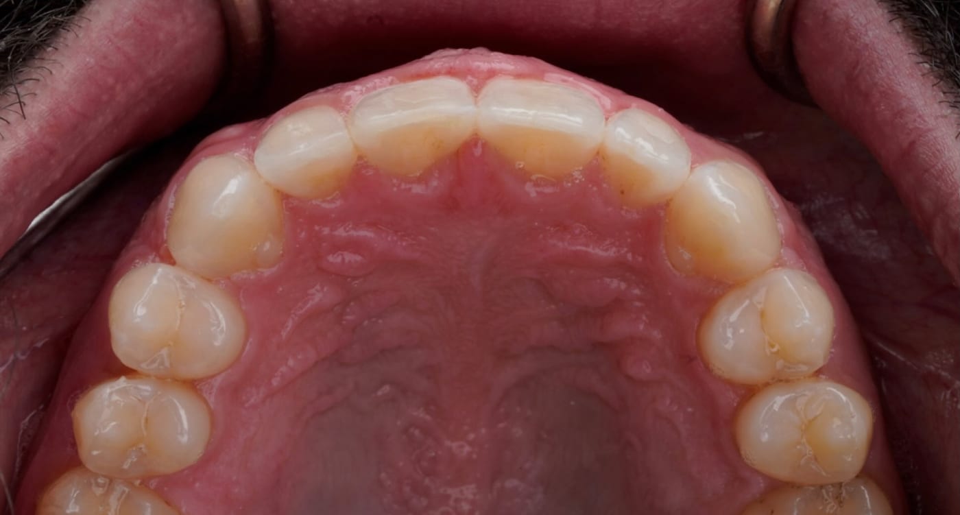 A crowded upper arch, straightened in one year, after