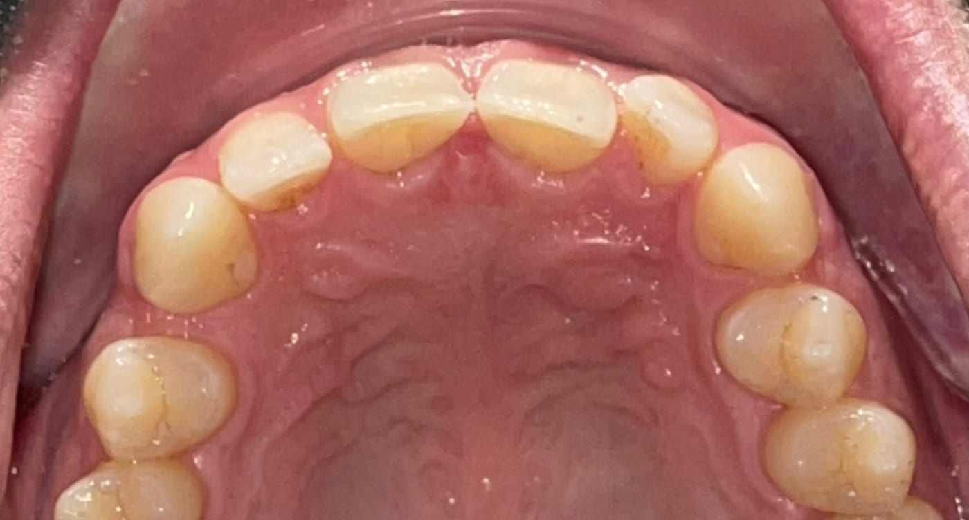 A crowded upper arch, straightened in one year, before