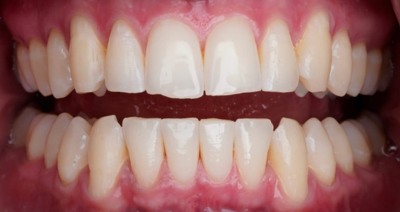 Lower front teeth aligned in six months, after