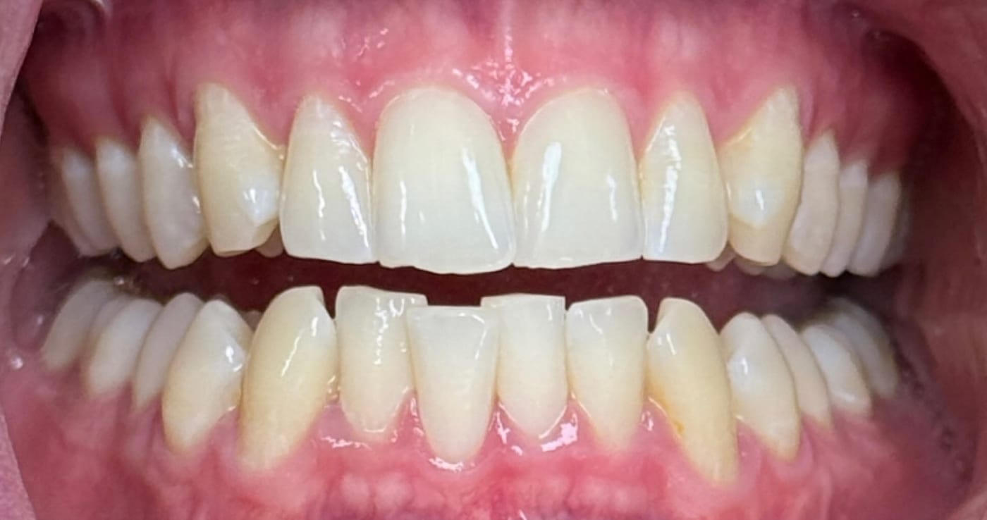 Lower front teeth aligned in six months, before