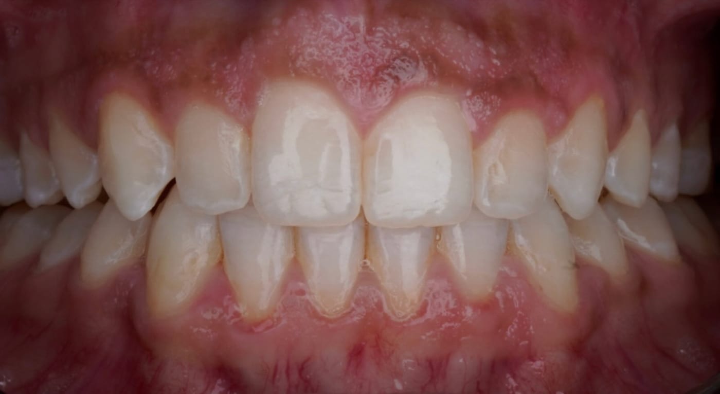 Long front teeth and a small gap, evened out, after
