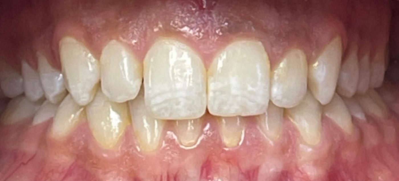 Long front teeth and a small gap, evened out, before