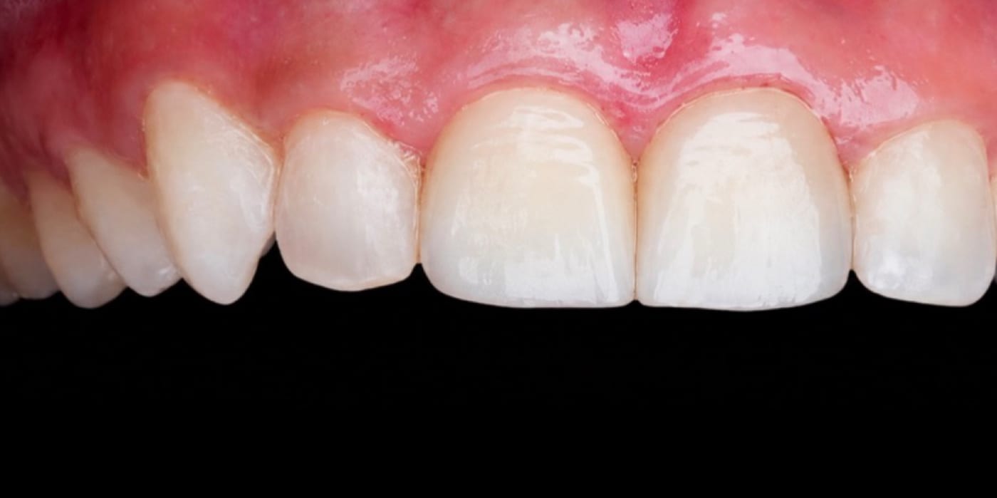 Invisalign, whitening, two veneers and bonding, after