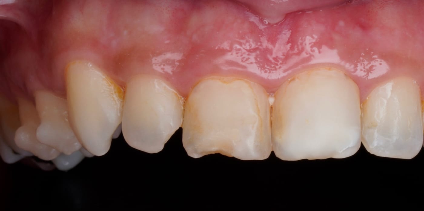 Invisalign, whitening, two veneers and bonding, before